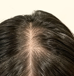 First analysis follicle view